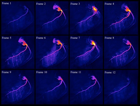 Time series of consecutive images acquired every second after injection of hyperpolarized water. Major and minor vessels of the coronary tree can easily be identified.